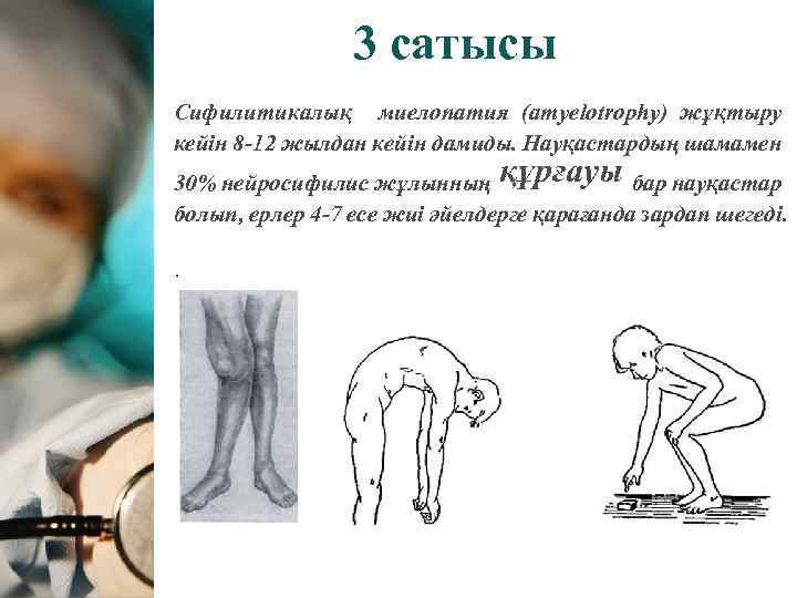 3 сатысы Сифилитикалық миелопатия (amyelotrophy) жұқтыру кейін 8 -12 жылдан кейін дамиды. Науқастардың шамамен