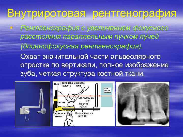Внутриротовая рентгенография § Рентгенография с увеличением фокусного расстояния параллельным пучком лучей (длиннофокусная рентгенография). Охват