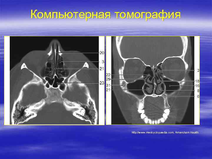 Компьютерная томография http: //www. medcyclopaedia. com, Amersham Health 