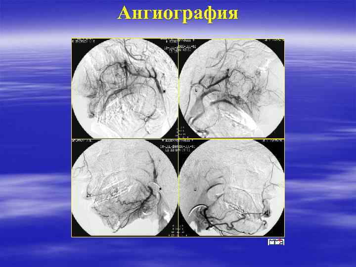 Ангиография 