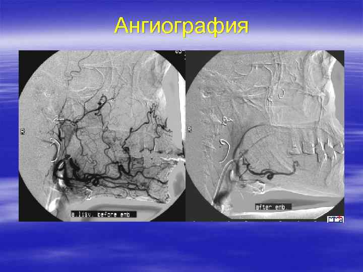 Ангиография 