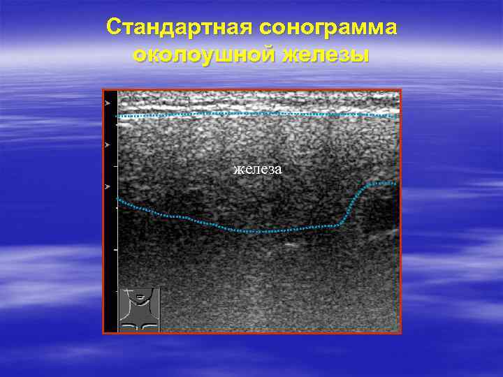 Стандартная сонограмма околоушной железы железа 
