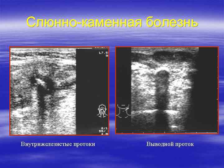 Слюнно-каменная болезнь Внутрижелезистые протоки Выводной проток 