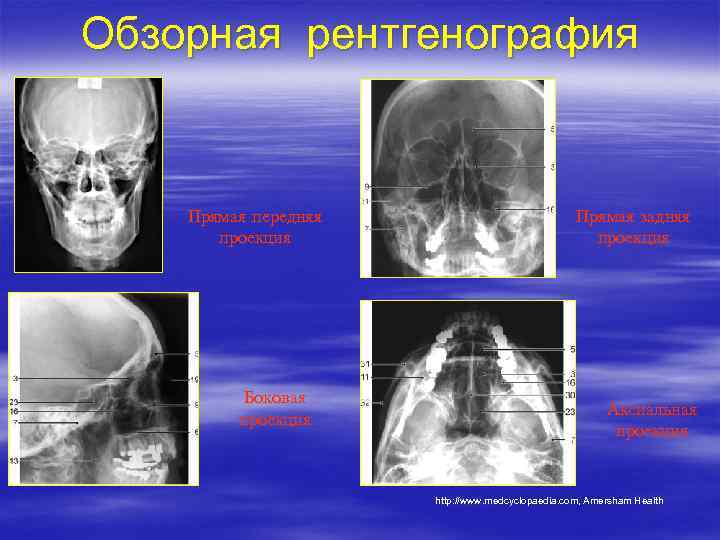 Рентгенография с прямым увеличением изображения применяется