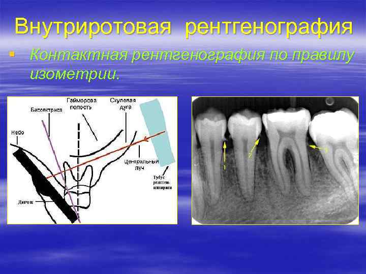 Внутриротовая рентгенография § Контактная рентгенография по правилу изометрии. 