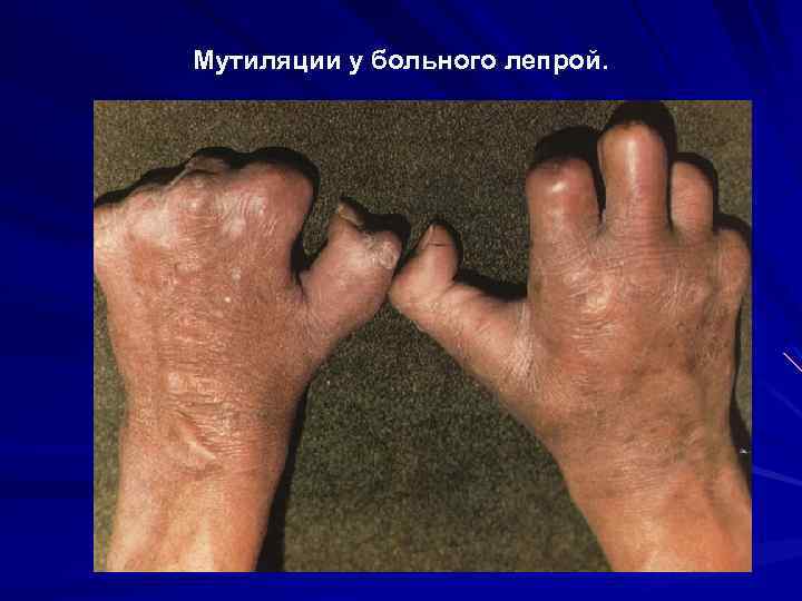 Мутиляции у больного лепрой. 