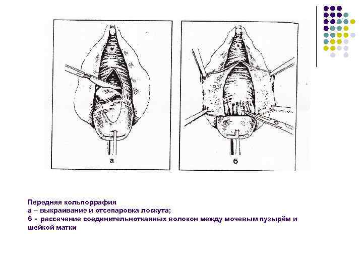 Передняя кольпоррафия а – выкраивание и отсепаровка лоскута; б - рассечение соединительнотканных волокон между