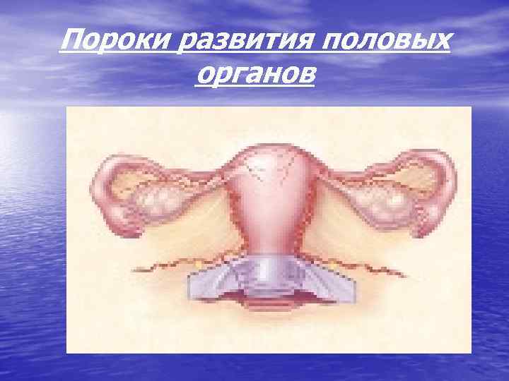 Пороки развития половых органов 