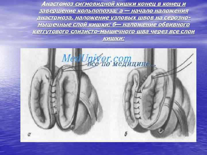 Анастомоз сигмовидной кишки конец в конец и завершение кольпопоэза; а — начало наложения анастомоза,