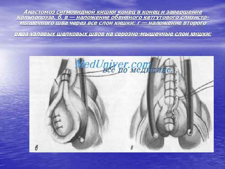 Анастомоз сигмовидной кишки конец в конец и завершение кольпопоэза. б, в — наложение обвивного