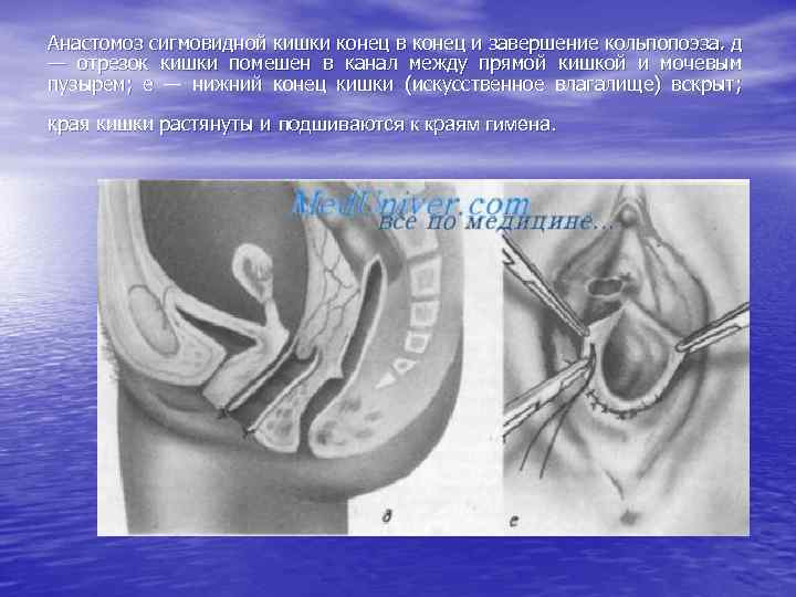 Анастомоз сигмовидной кишки конец в конец и завершение кольпопоэза. д — отрезок кишки помешен