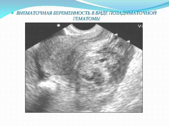  ВНЕМАТОЧНАЯ БЕРЕМЕННОСТЬ В ВИДЕ ПОЗАДИМАТОЧНОЙ ГЕМАТОМЫ 