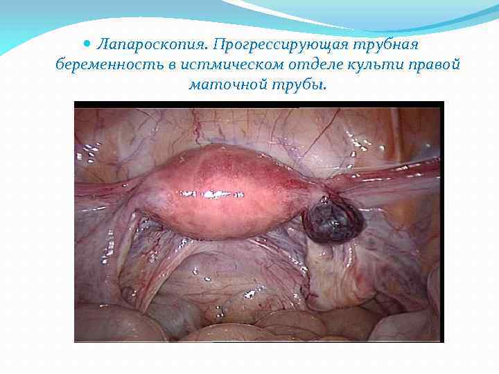  Лапароскопия. Прогрессирующая трубная беременность в истмическом отделе культи правой маточной трубы. 