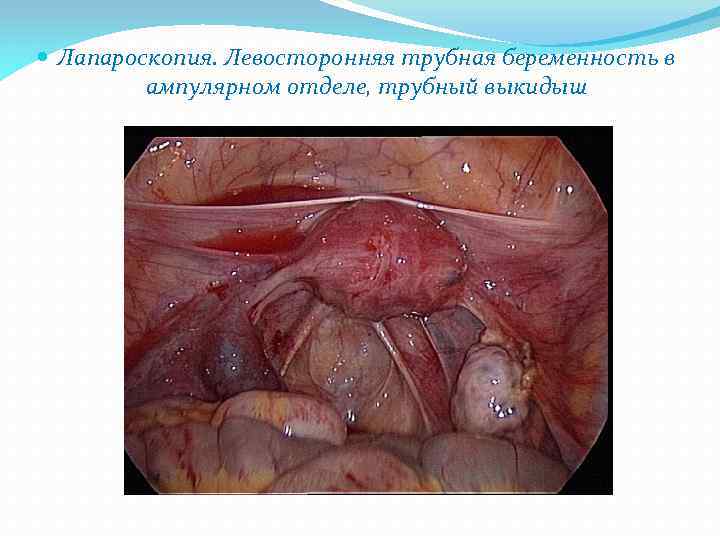  Лапароскопия. Левосторонняя трубная беременность в ампулярном отделе, трубный выкидыш 