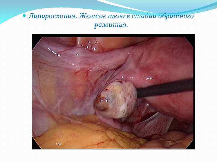  Лапароскопия. Желтое тело в стадии обратного развития. 