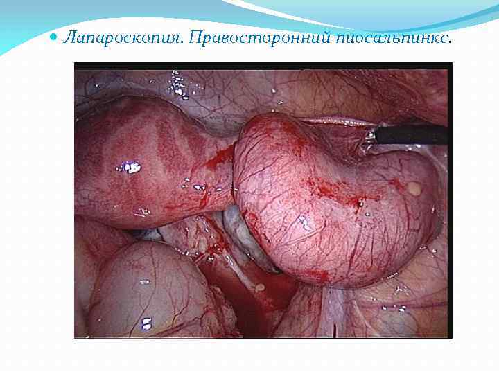  Лапароскопия. Правосторонний пиосальпинкс. 