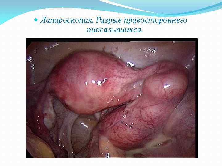  Лапароскопия. Разрыв правостороннего пиосальпинкса. 