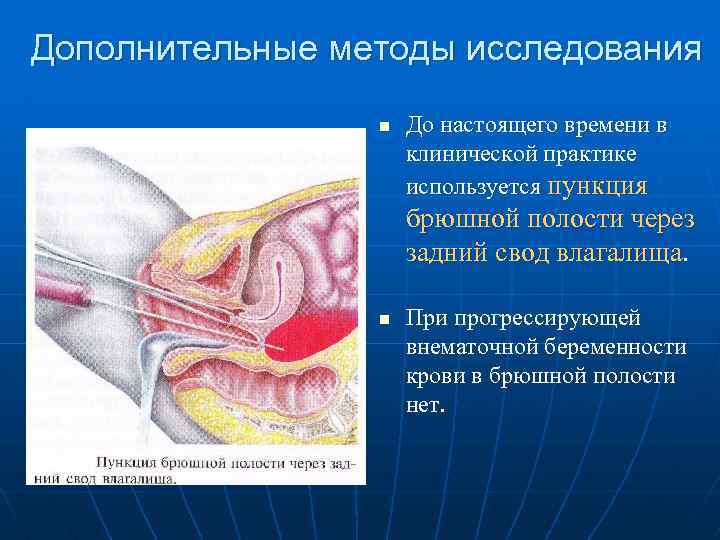 Дополнительные методы исследования n До настоящего времени в клинической практике используется пункция брюшной полости