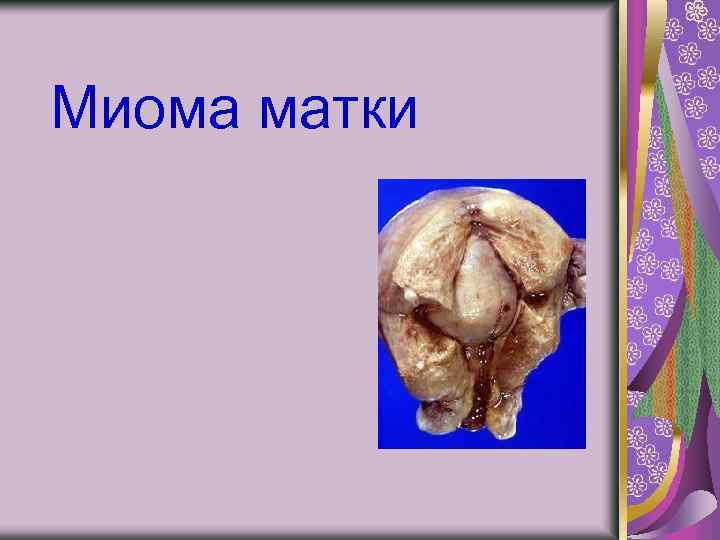 Миома матки 