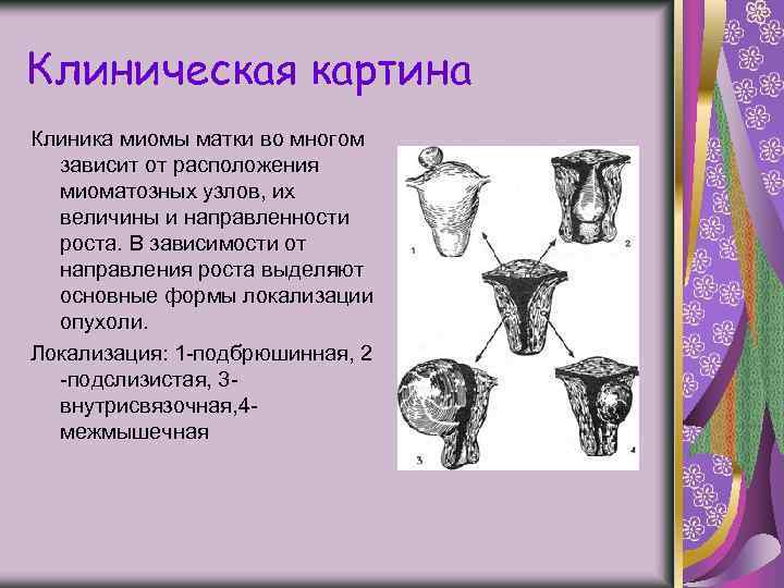 Центр миомы. Клиническая картина миомы матки.