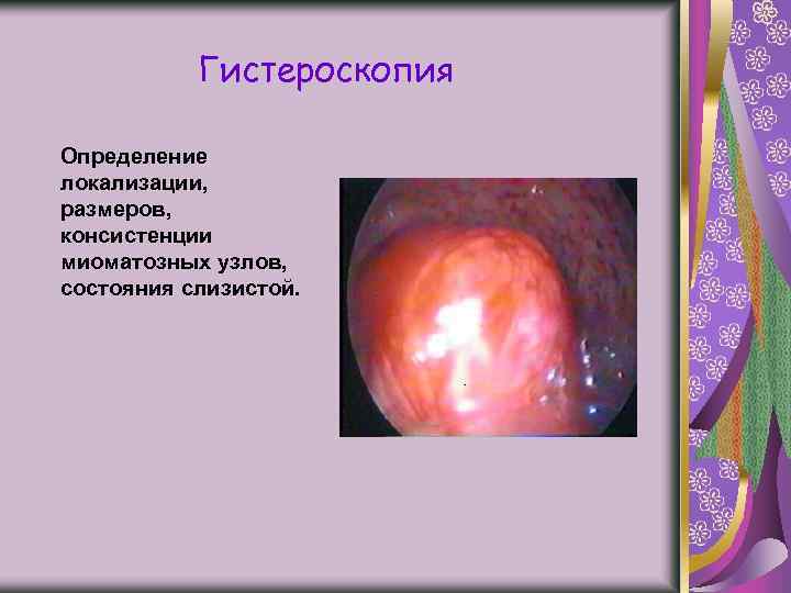 Гистероскопия Определение локализации, размеров, консистенции миоматозных узлов, состояния слизистой. 