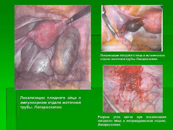 Локализация плодного яйца в истмическом отделе маточной трубы. Лапароскопия. Локализация плодного яйца в ампуллярном