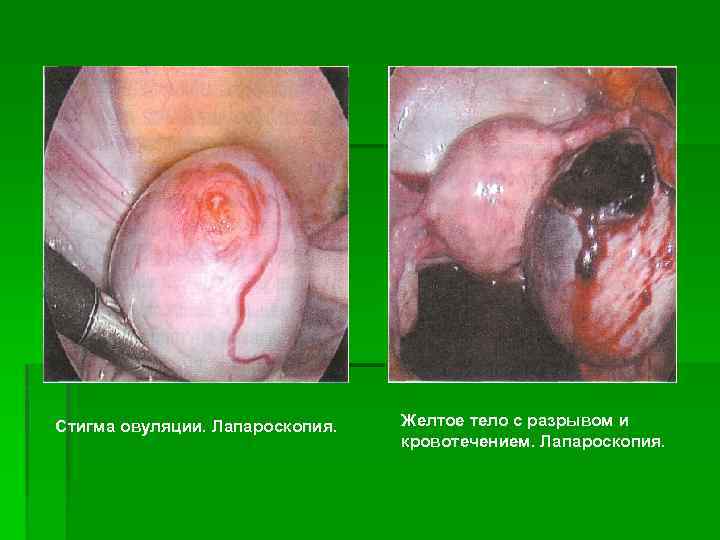 Стигма овуляции. Лапароскопия. Желтое тело с разрывом и кровотечением. Лапароскопия. 