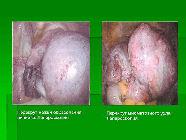 Перекрут ножки образования яичника. Лапароскопия Перекрут миоматозного узла. Лапароскопия. 