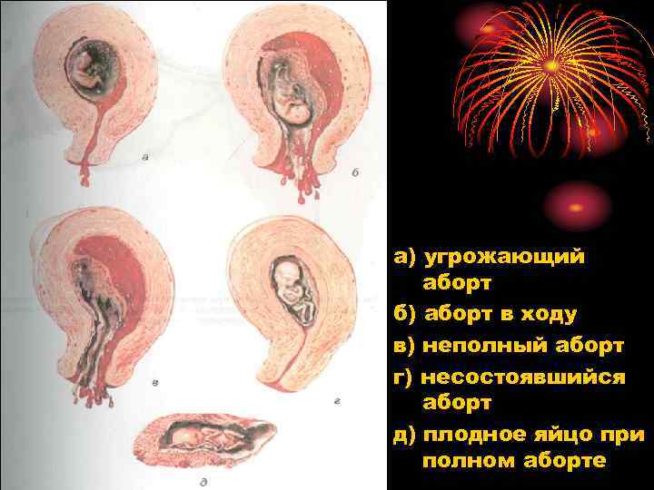 а) угрожающий аборт б) аборт в ходу в) неполный аборт г) несостоявшийся аборт д)