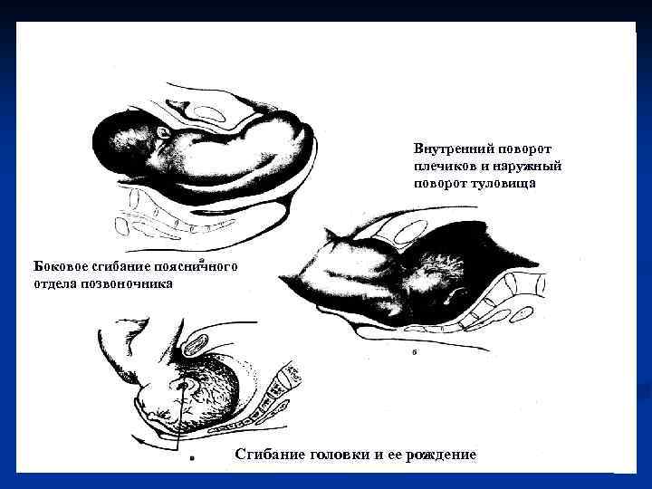 Упражнения для тазового предлежания