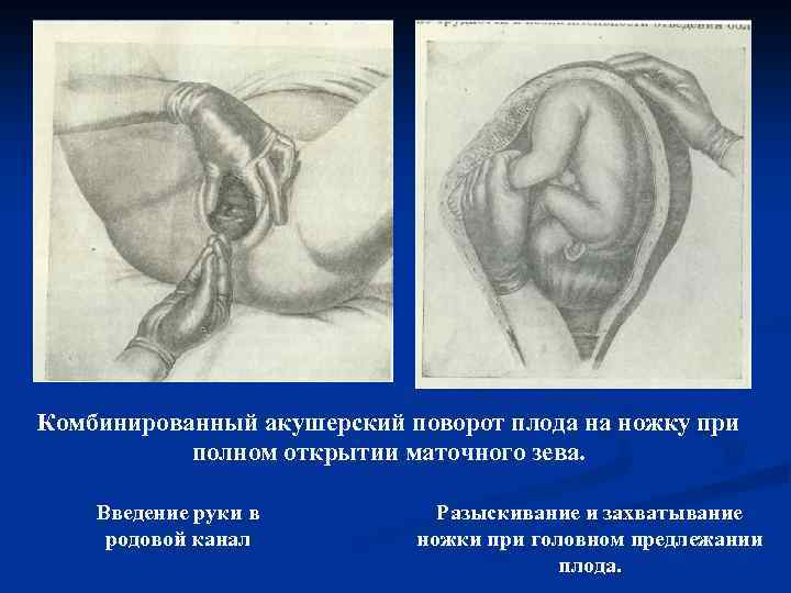 Комбинированный акушерский поворот плода на ножку при полном открытии маточного зева. Введение руки в