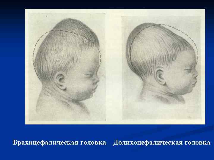 Долихоцефалическая форма головы у ребенка фото
