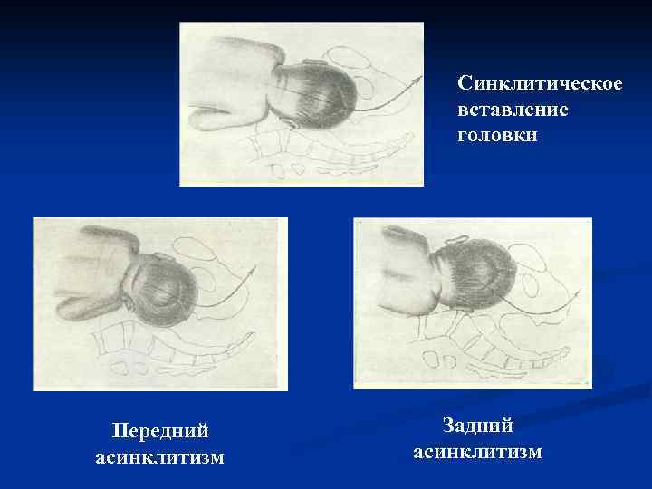 Вставление головки виды