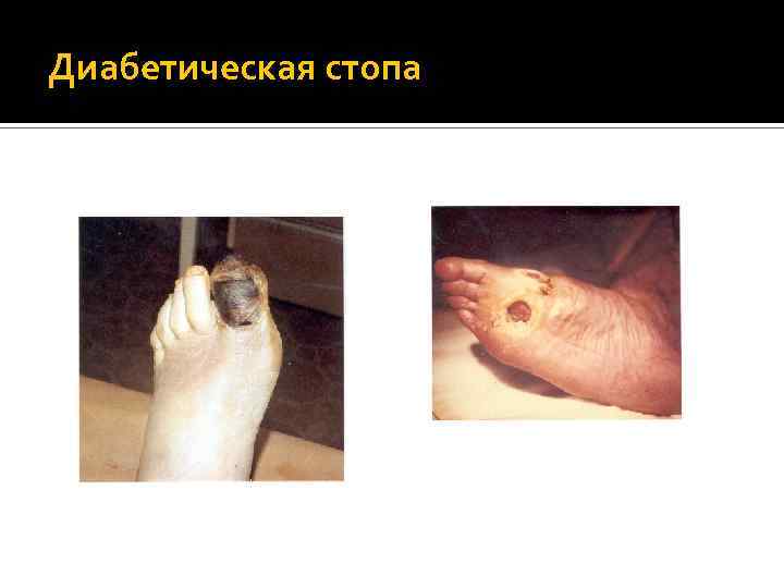 Диабетическая стопа 