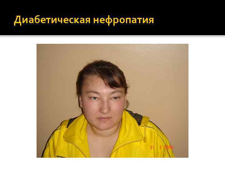 Диабетическая нефропатия 