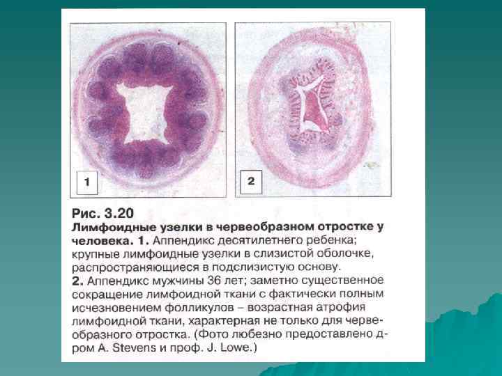 Перифиссурально узелки. Лимфоидные узелки аппендикса. Лимфоидная ткань червеобразного отростка. Лимфоидные фолликулы в аппендиксе. Лимфоидные узелки червеобразного отростка.