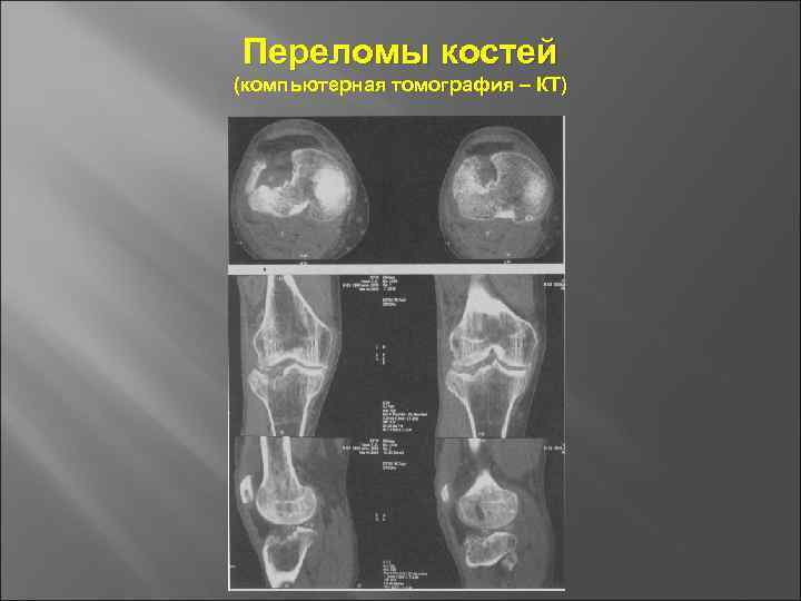 Переломы костей (компьютерная томография – КТ) 