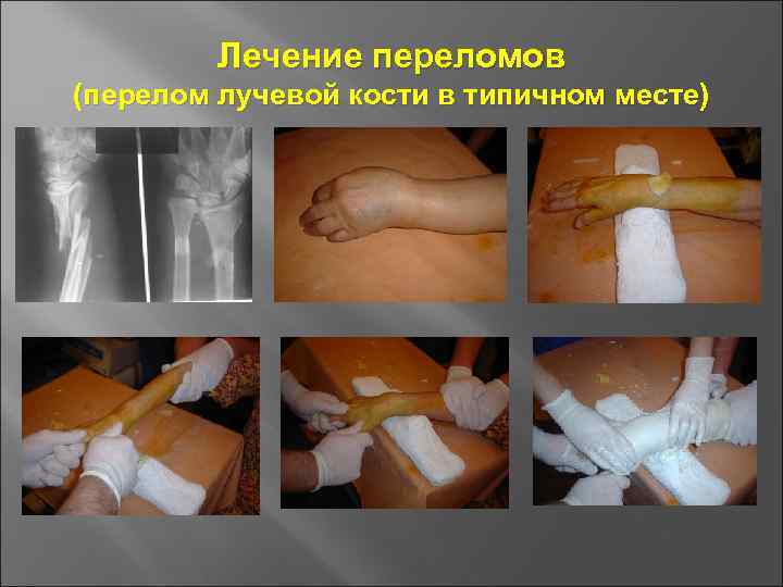 Лечение переломов (перелом лучевой кости в типичном месте) 
