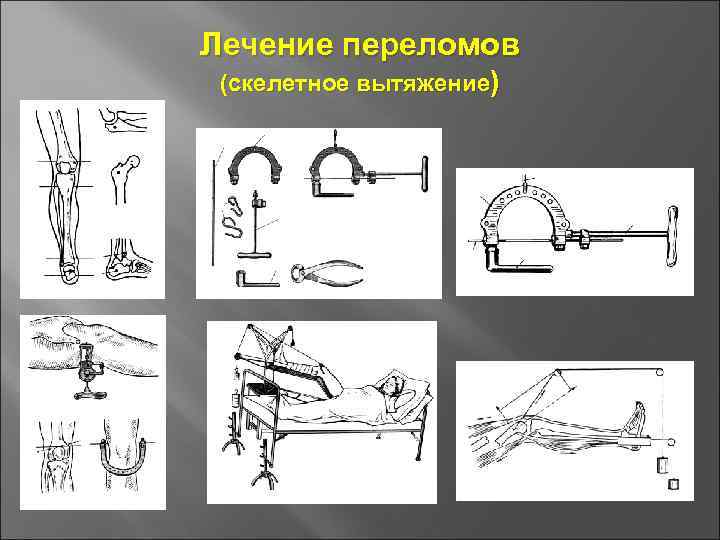 Лечение переломов презентация