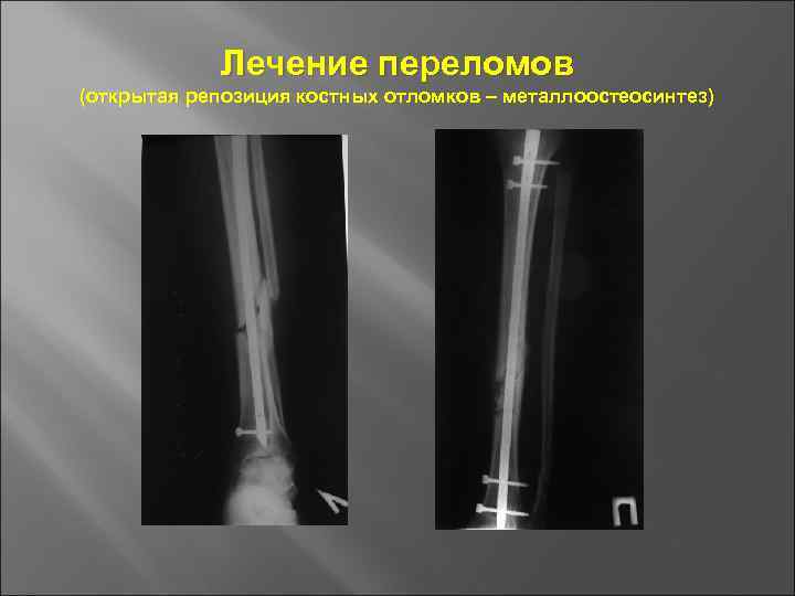 Презентация по травматологии