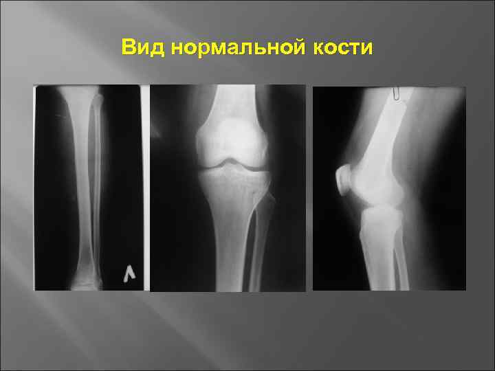 Вид нормальной кости 
