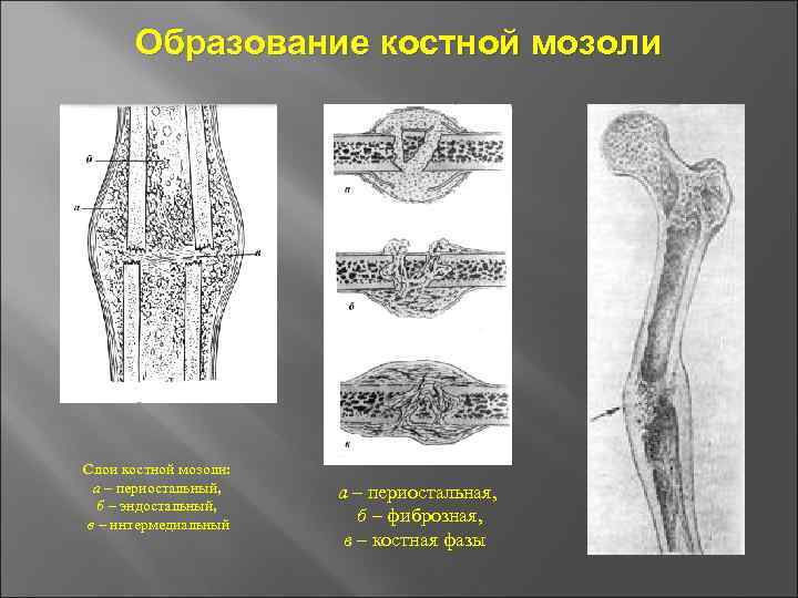 Образование костной мозоли Слои костной мозоли: а – периостальный, б – эндостальный, в –