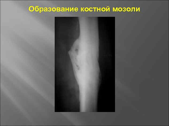 Образование костной мозоли 