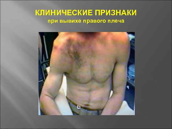 КЛИНИЧЕСКИЕ ПРИЗНАКИ при вывихе правого плеча 