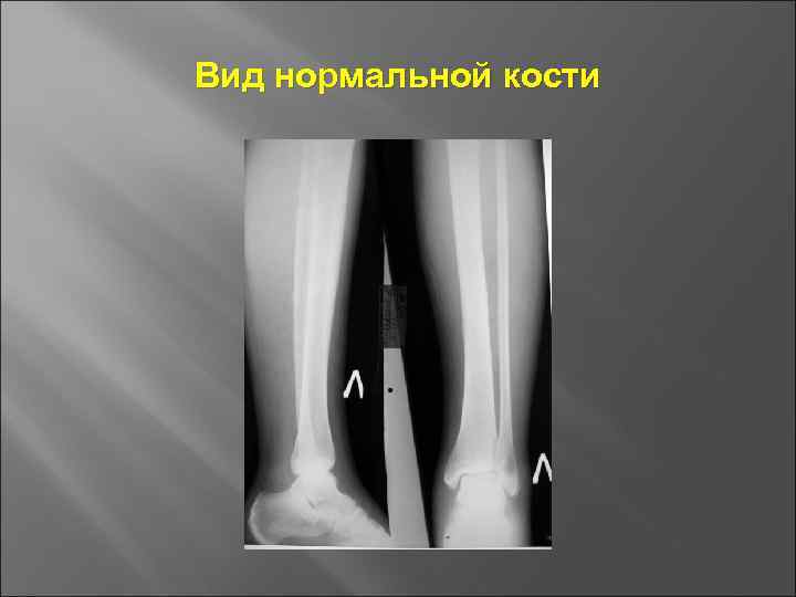 Вид нормальной кости 