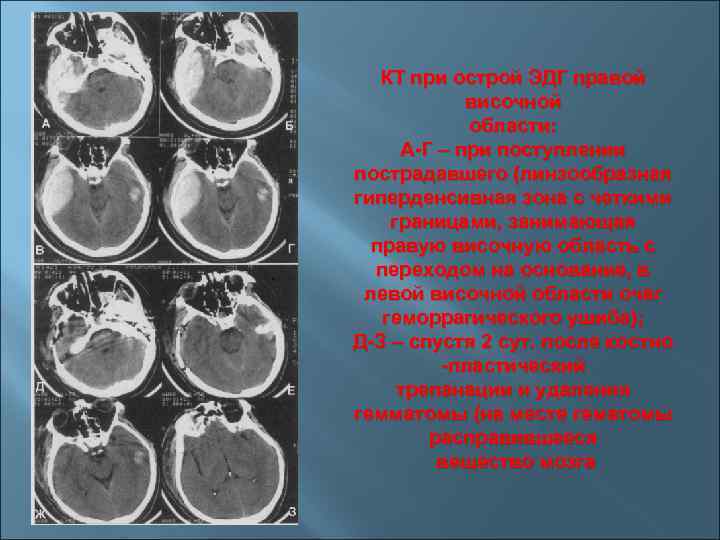 КТ при острой ЭДГ правой височной области: А-Г – при поступлении пострадавшего (линзообразная гиперденсивная