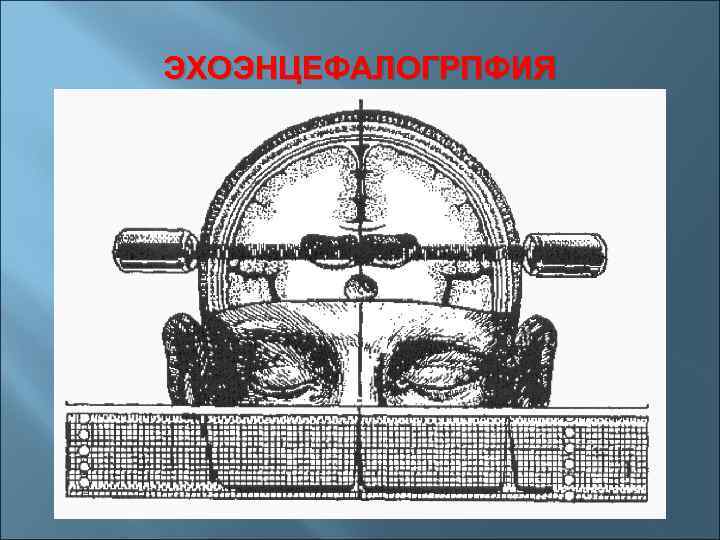 ЭХОЭНЦЕФАЛОГРПФИЯ 