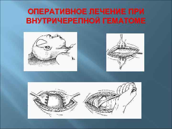ОПЕРАТИВНОЕ ЛЕЧЕНИЕ ПРИ ВНУТРИЧЕРЕПНОЙ ГЕМАТОМЕ 