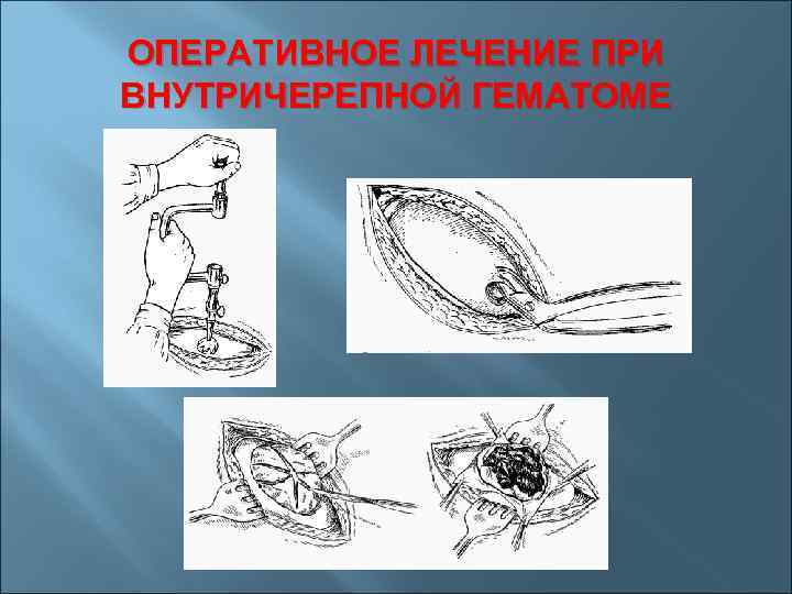 ОПЕРАТИВНОЕ ЛЕЧЕНИЕ ПРИ ВНУТРИЧЕРЕПНОЙ ГЕМАТОМЕ 