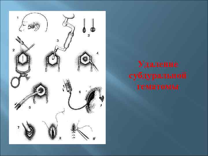 Удаление субдуральной гематомы 